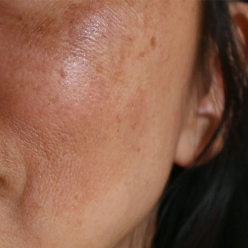 How to prevent brown spots on the skin?